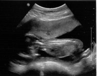 A grainy and blurry black and white photo of a baby in utero